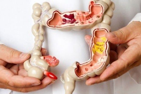 3. Sindrom iritasi usus