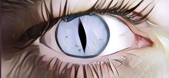 Berbagai Kelainan Langka Pada Mata Manusia