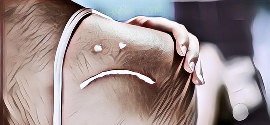 Jangan Dibiarkan, Begini Cara Mengatasi Sunburn Pada Kulit Secara Alami