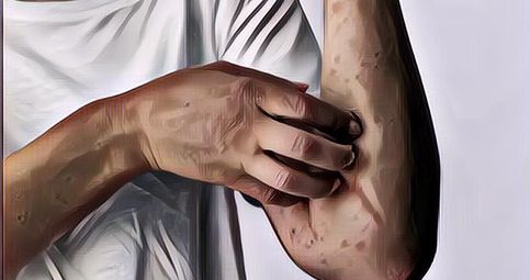 Terpapar Sinar Matahari Berlebih Bisa Sebabkan Kulit Terpapar Fotodermatitis