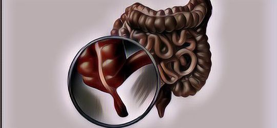 Seluk Beluk Penyakit Usus Buntu, Apa Penyebab dan Bagaimana Mencegahnya?