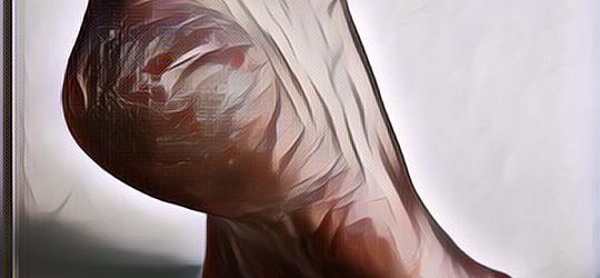 7 Langkah Jitu Menangani Kaki Pecah-Pecah, Ampuh Bangets