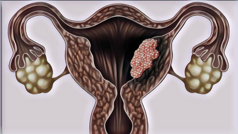 Selain Vaksin, Ini 5 Makanan yang Bisa Cegah Kanker Serviks