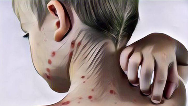 Ternyata, Ini Penyebab Adanya Penyakit Cacar Monyet