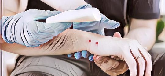 Ciri-Ciri Ular Berbisa dan Pertolongan Pertama pada Gigitan Ular Berbisa