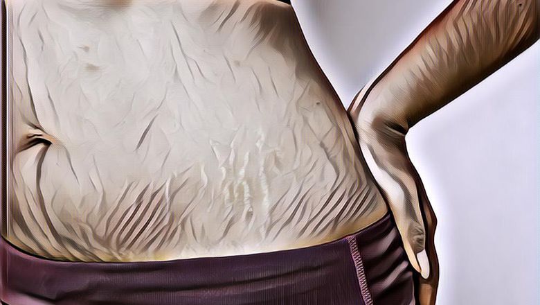 Bikin Makin Percaya Diri, Ini 4 Rekomendasi Body Oil Untuk Menghilangkan Stretch Mark