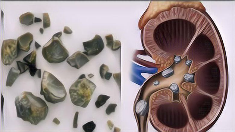 Waspadai 7 Gejala Penyakit Batu Ginjal, Salah Satunya Sakit Pinggang
