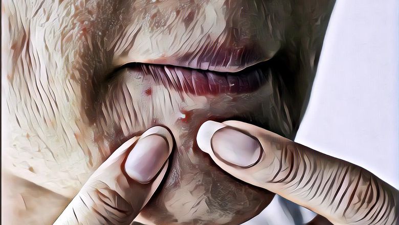 Jerawat Hormon Kapan Bisa Hilang? Ini Kata Dokter