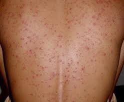 3. Jerawat Conglobata