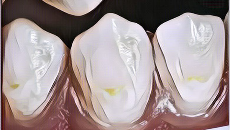 Lebih dari Permen, 13 Makanan Ini Bisa Merusak Gigi