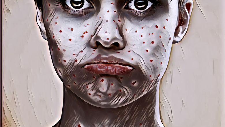 5 Mitos Populer tentang Cacar Air, Benarkah Hanya Sekali Seumur Hidup? Cek Faktanya Yuk!