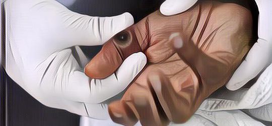 Bikin Was-Was, Kasus Cacar Monyet di RI Semakin Meningkat!