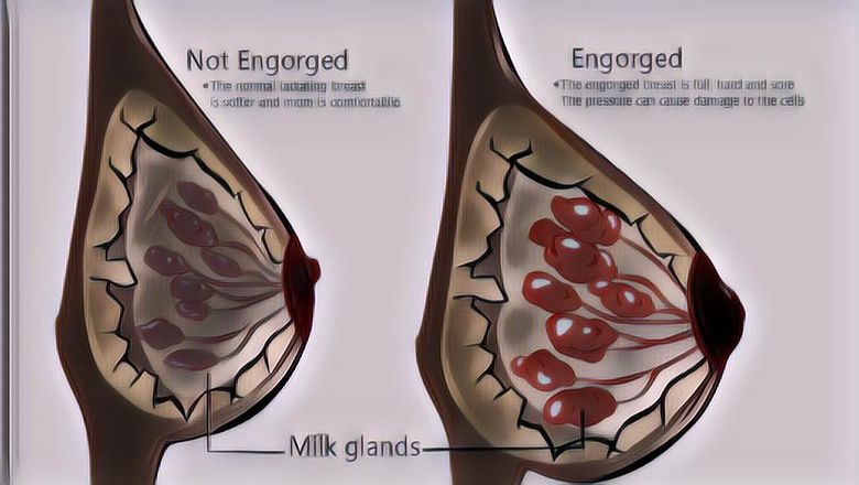 Segala Hal yang Perlu Kamu Tahu Soal ASI Tersumbat, Bisa Dihindari dan Ditangani Kok!