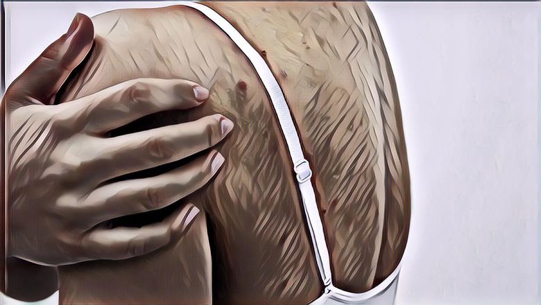 Punya Jerawat Punggung? Yuk Kupas Tuntas Cara Bersihkannya