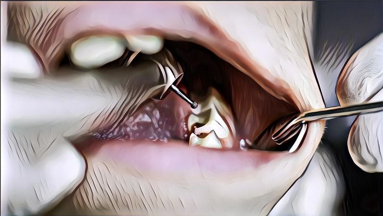 Biar Nggak Makin Parah, Kenali Tanda-Tanda Awal Gigi Berlubang