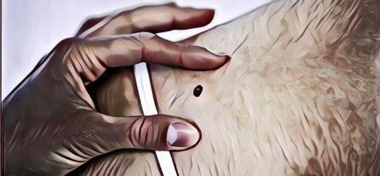 Fakta Mengenai Melanoma, Kanker Kulit yang Bisa Kamu Derita Karena Efek Buruk Sinar UV