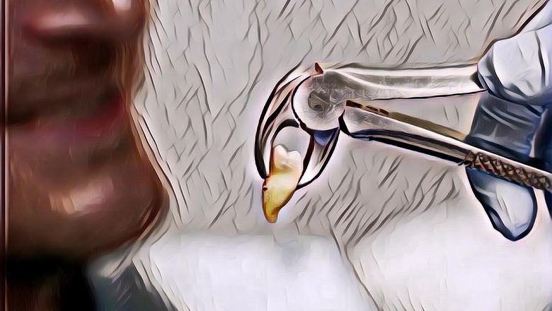 9 Hal yang Bisa Kamu Lakukan untuk Perawatan Setelah Cabut Gigi