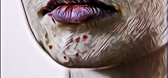 Bingung dengan Kondisi Jerawat Hormon Seperti Apa? Begini Ciri-Cirinya