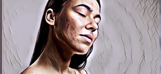 Sering Mengalami Wajah Breakout? Jangan-jangan Kamu Sering Melakukan 5 Hal Ini, Ladies