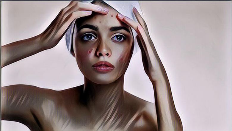 Jangan Dilakukan Lagi, Ternyata Ini Lho 3 Kebiasaan yang Menyebabkan Jerawat Rajin Datang