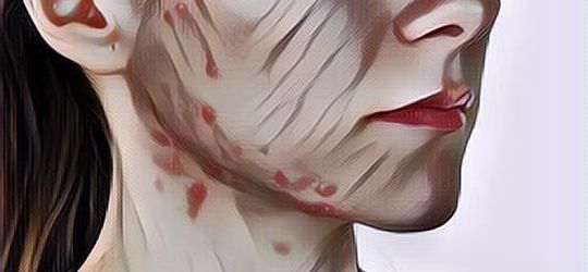 Mengenali Jenis-Jenis Jerawat Yang Biasa Muncul Di Wajah… Ternyata Beda-Beda Banget!