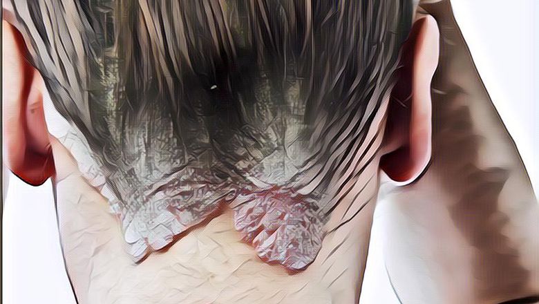 Mirip Sih! Tapi Ini Lho Perbedaan Ketombe dan Psoriasis