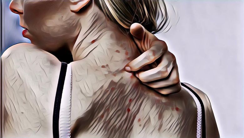 Mudah Dilakukan, Begini Tips Menghilangkan Jerawat Punggung yang Mengganggu