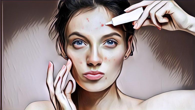 5 Cara Ampuh Mengatasi Jerawat di Area T-Zone