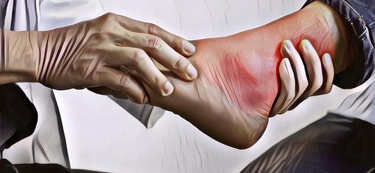 Obat Asam Urat: Kamu Nggak Usah Panik Lagi