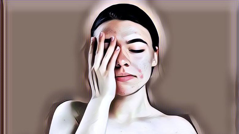 Cara Mengatasi Jerawat pada Remaja, Bye Bye Breakout!