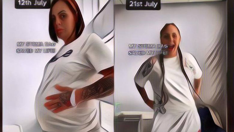 Wanita Dikira Hamil 8 Bulan, Ternyata Ini Penyebab Perutnya Membesar