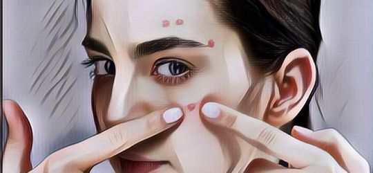 Mudah dan Murah, Ini 5 Bahan Alami Dipercaya Ampuh Hilangkan Bekas Jerawat Menghitam