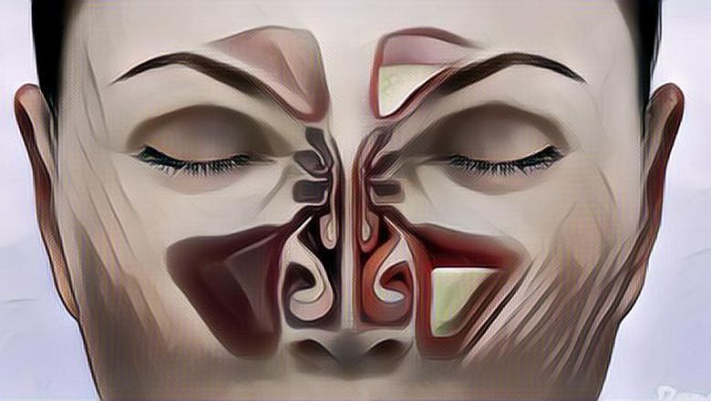Penyebab dan Gejala Sinusitis, Mulai dari yang Ringan Hingga Berat