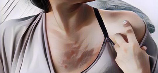 Angka Pengidap Kanker Payudara di Indonesia Masih Tinggi, Bagaimana Cara Mengatasinya?