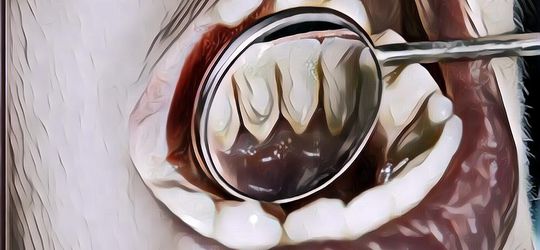 5 Cara Membersihkan Karang Gigi, Gigi Jadi Sehat Cemerlang!