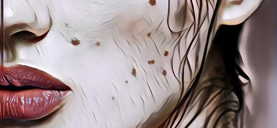 Perlukah Menghilangkan Tahi Lalat? Cek Faktanya Dulu, Yuk!