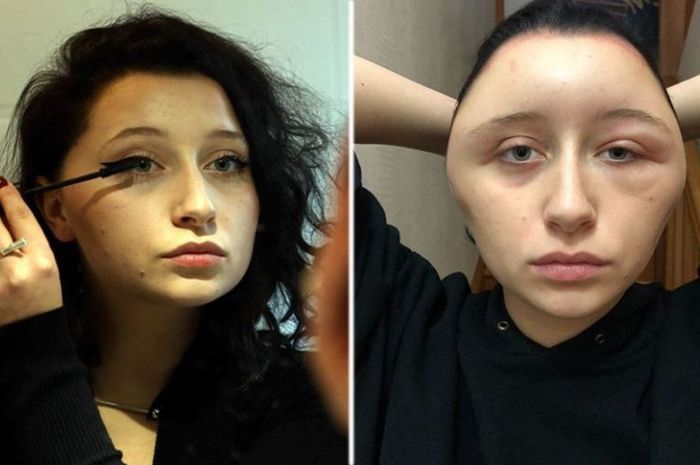 2. Alergi cat rambut sebabkan "kepala bohlam"