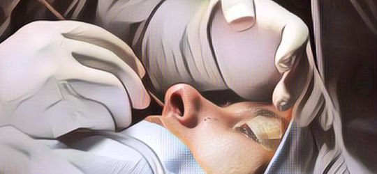 Hiih Merinding! Dokter Ini Keluarkan 145 Belatung di Hidung Pria Ini