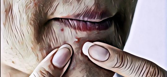 Jerawat Hormon Kapan Bisa Hilang? Ini Kata Dokter