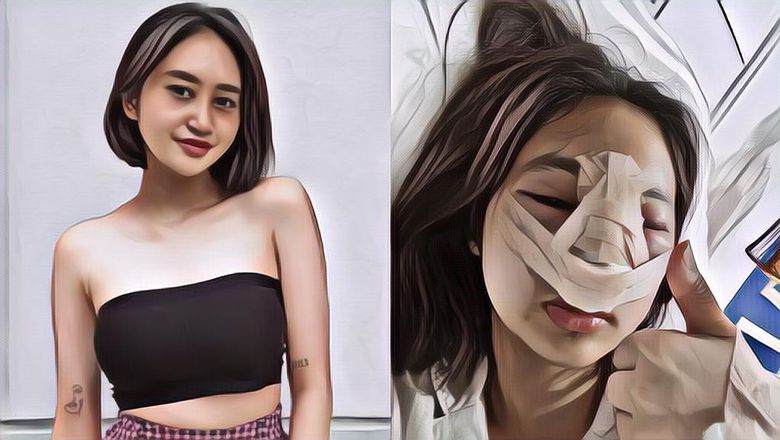 Oplas Demi Hidung Mancung, Anak Farida Nurhan Alami Infeksi Implan Parah Dan Bengkak Dari Mata Sampai Pipi, Gini Kondisinya!