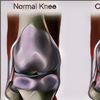 Mengenal Apa Itu Osteoarthritis dan Gejalanya yang Paling Umum