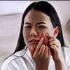Begadang Jadi Picu Jerawat di Wajah: Apa Benar?