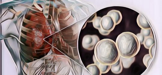 Mengenal Penyakit Pneumonia yang Menyebabkan Aktris Taiwan Barbie Hsu Meninggal, Seberbahaya Apa?