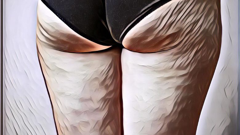 Cara Menghilangkan Selulit Secara Alami, Tanpa Krim atau Obat tapi Ampuh!