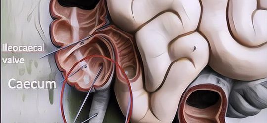 Seluk Beluk Penyakit Usus Buntu: Penyebab dan Cara Mencegahnya