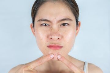 3. Jerawat Bermunculan