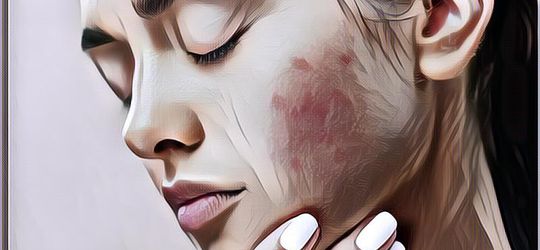 Gak Disadari! 5 Kebiasaan Buruk Saat Olahraga Ini Bisa Bikin Jerawat Muncul, Jangan Diulangi Ya