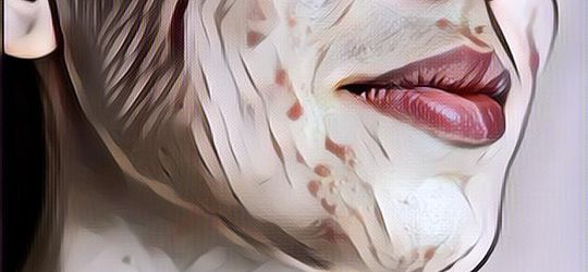 3 Cara Alami dan Aman Hilangkan Bekas Jerawat, Bisa Dilakukan di Rumah