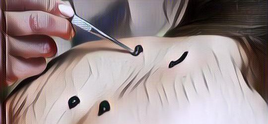 Hebat Banget! Ini Dia 5 Manfaat Terapi Lintah untuk Kesehatan