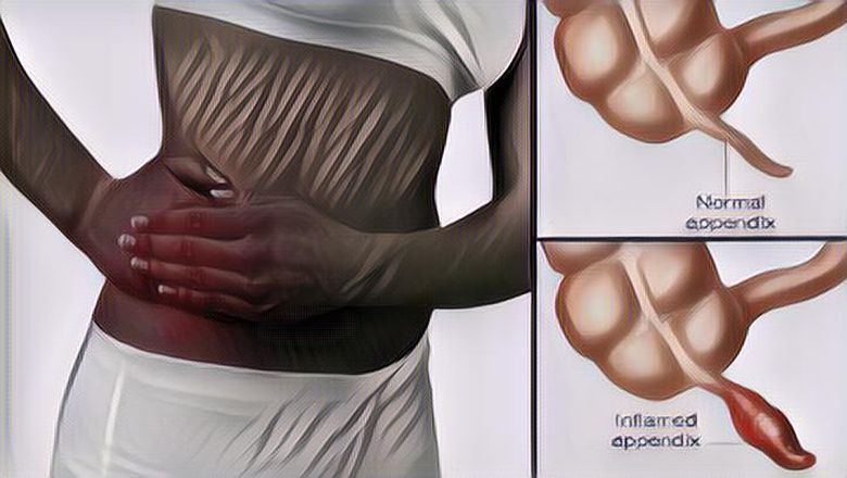 Segala Hal yang Perlu Kamu Tahu tentang Penyakit Usus Buntu